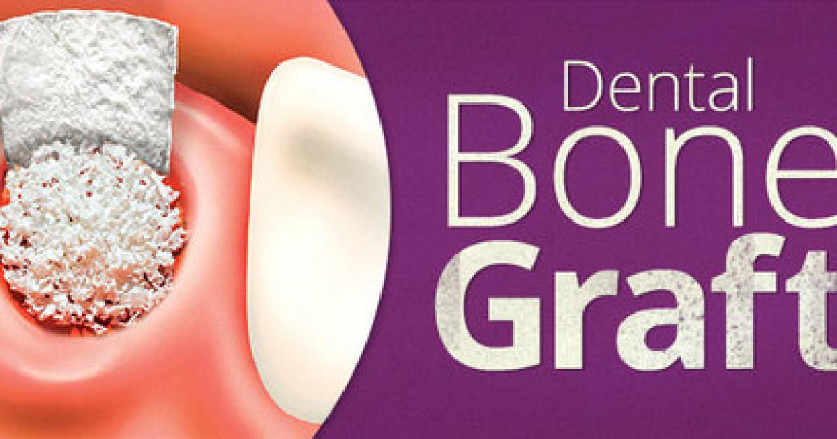Dental bone graft treatments, Los Algodones Mexico Dentists, Oral Bone Graft Specialists