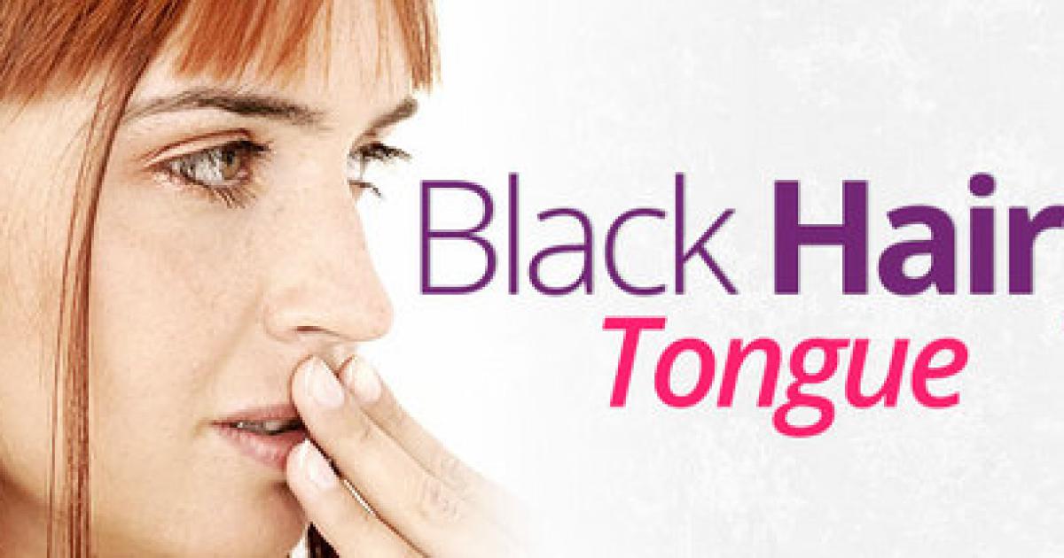 Dental pathologies, Black Hairy Tongue, Treatment, Dentists Los Algodones