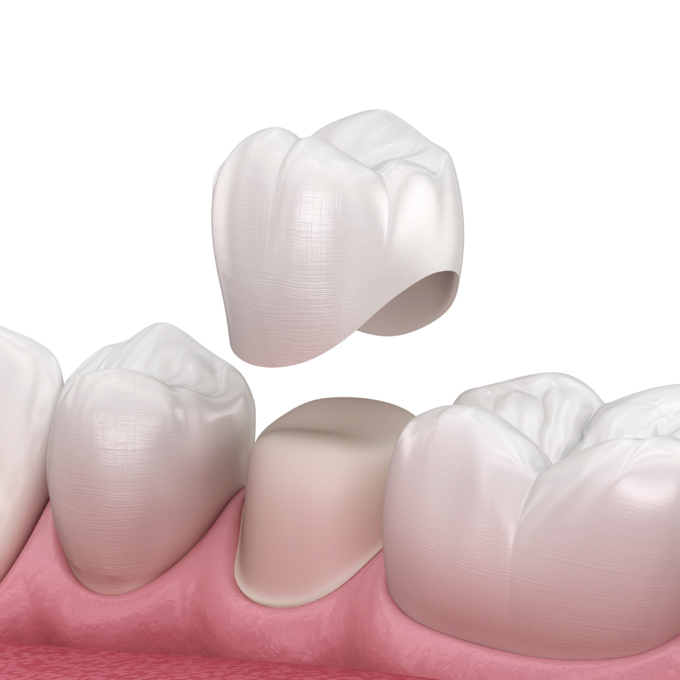 dental-crowns