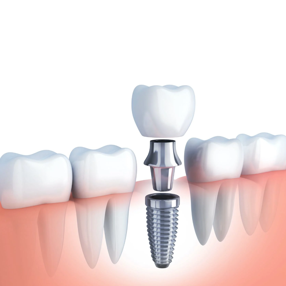 dental-implants