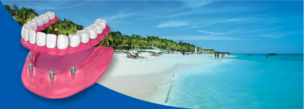 All-on-4 Dental Implants in Playa del Carmen: Your Complete Guide