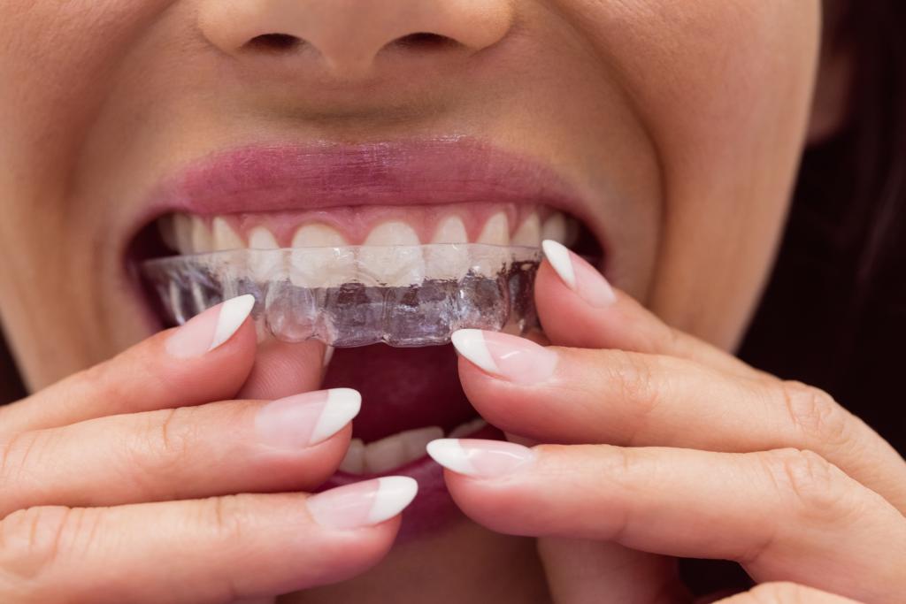 How Do Teeth Aligners Work and Why Are They So Popular?