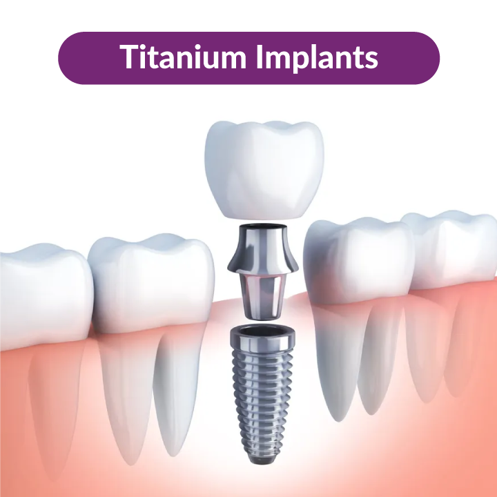 titanium-tooth-implant