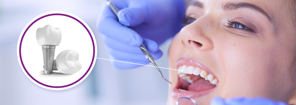 What are dental implants made of?