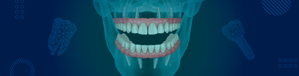 Full Mouth Dental Implants in Mexico for US Patients – Complete Smile Restoration in Playa del Carmen