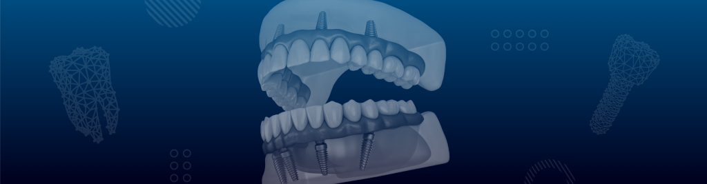 All-on-4 Dental Implants in Mexico – Cost, Care & Full Arch Solutions