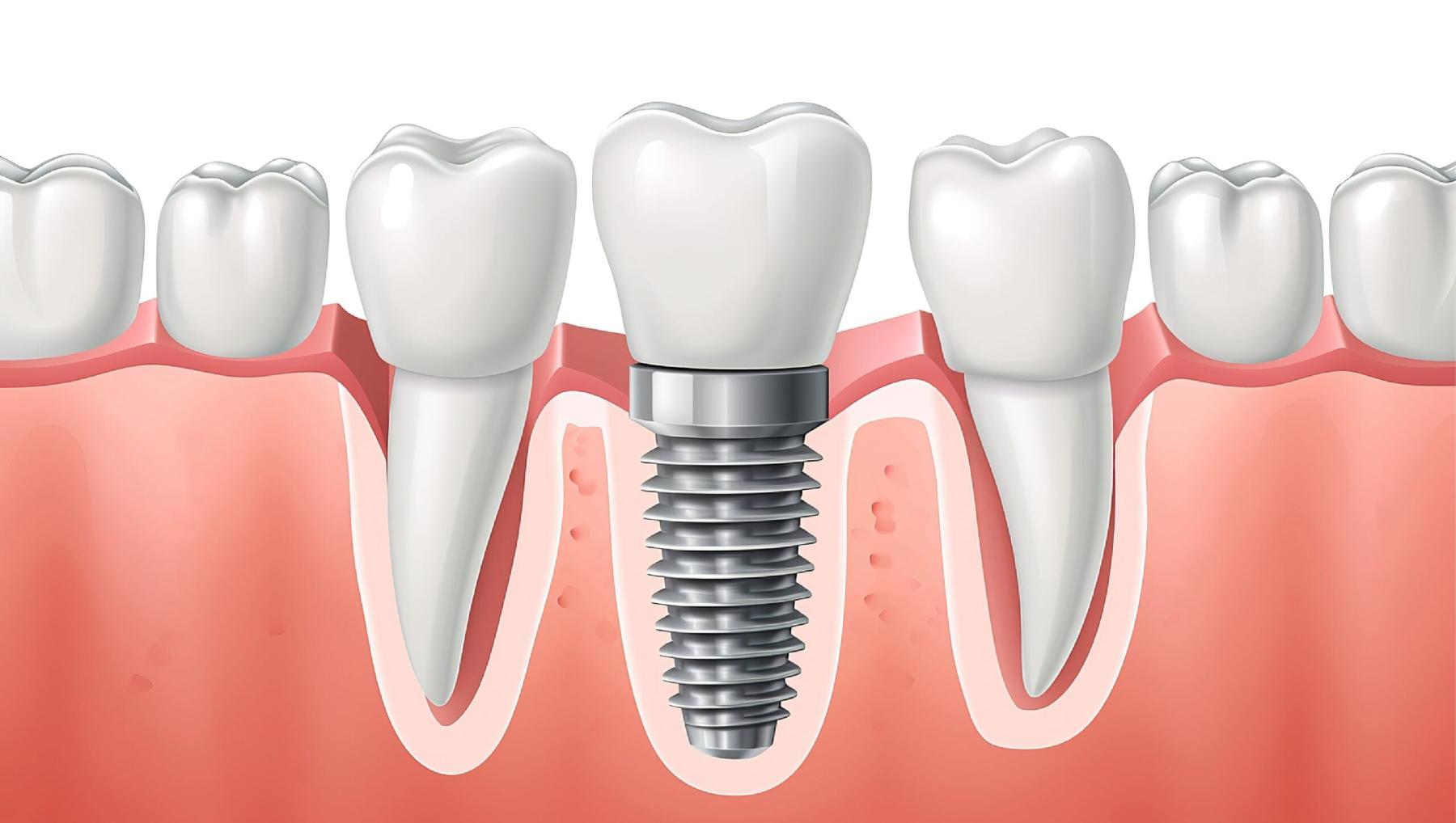 titanium dental implant components including abutment and crown