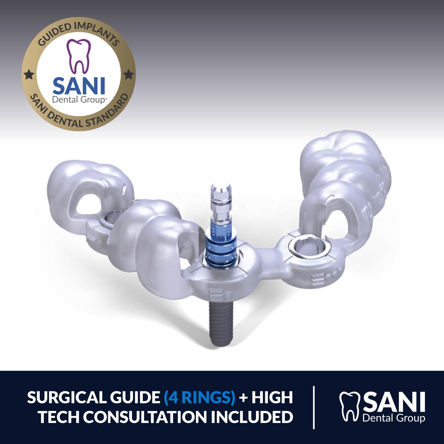 guided dental implant surgery using digital technology