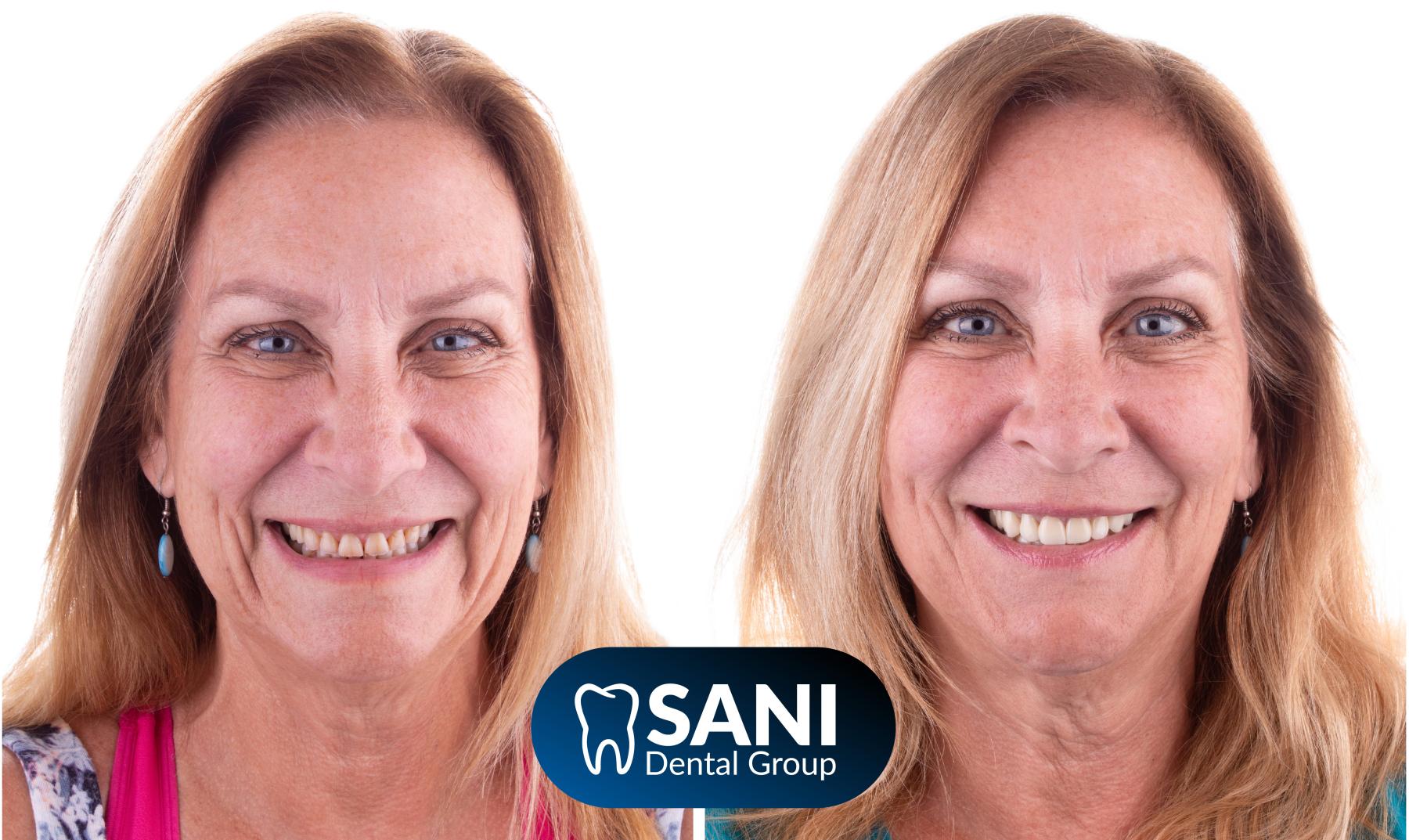 Affordable smile makeover in Mexico with natural-looking results