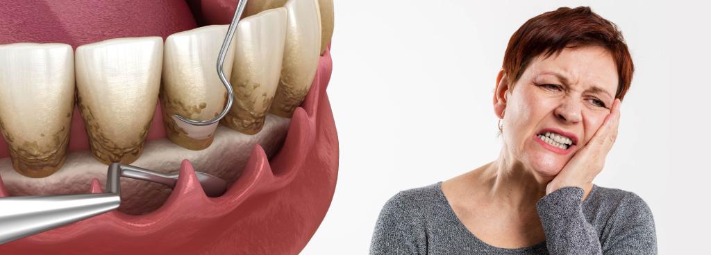 What are the Stages of Periodontal Disease?