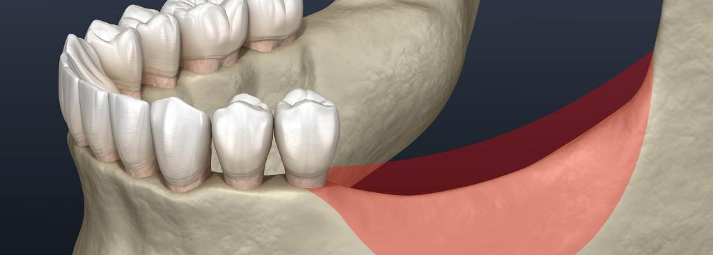 What causes bone loss in teeth?