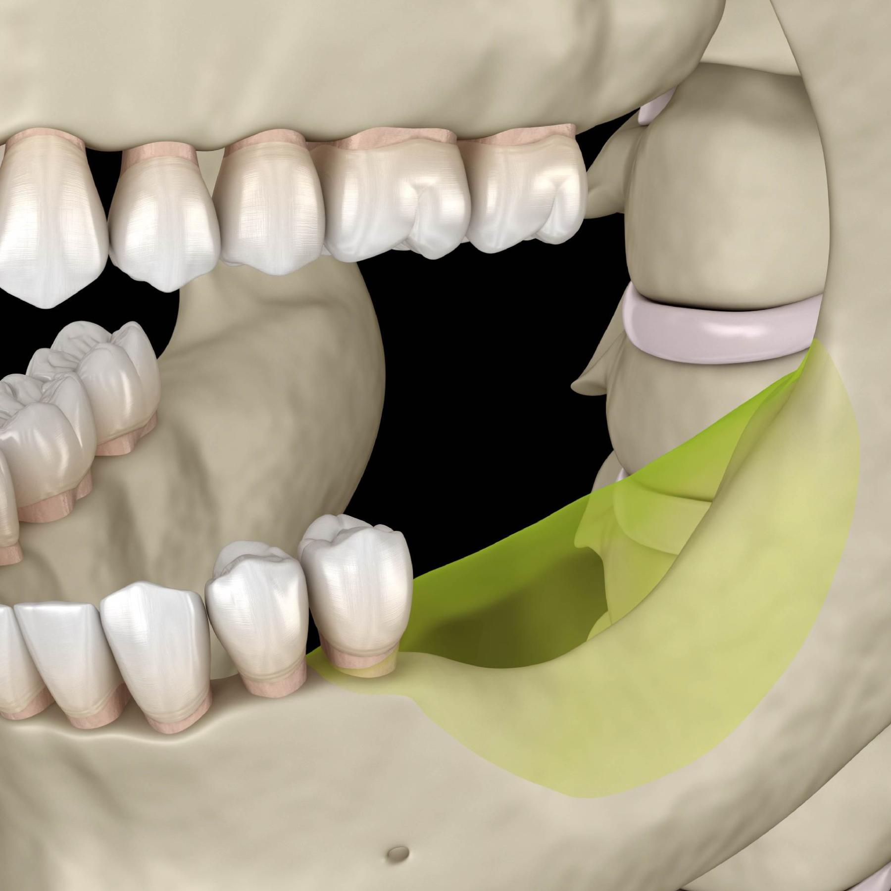 bone-loss-after-tooth-extraction
