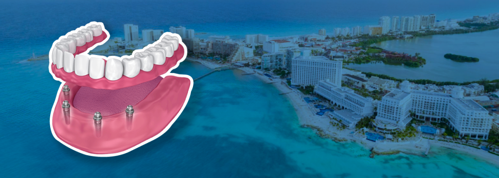 All-on-4 Dental Implants in Cancun: The Ultimate Dental Solution