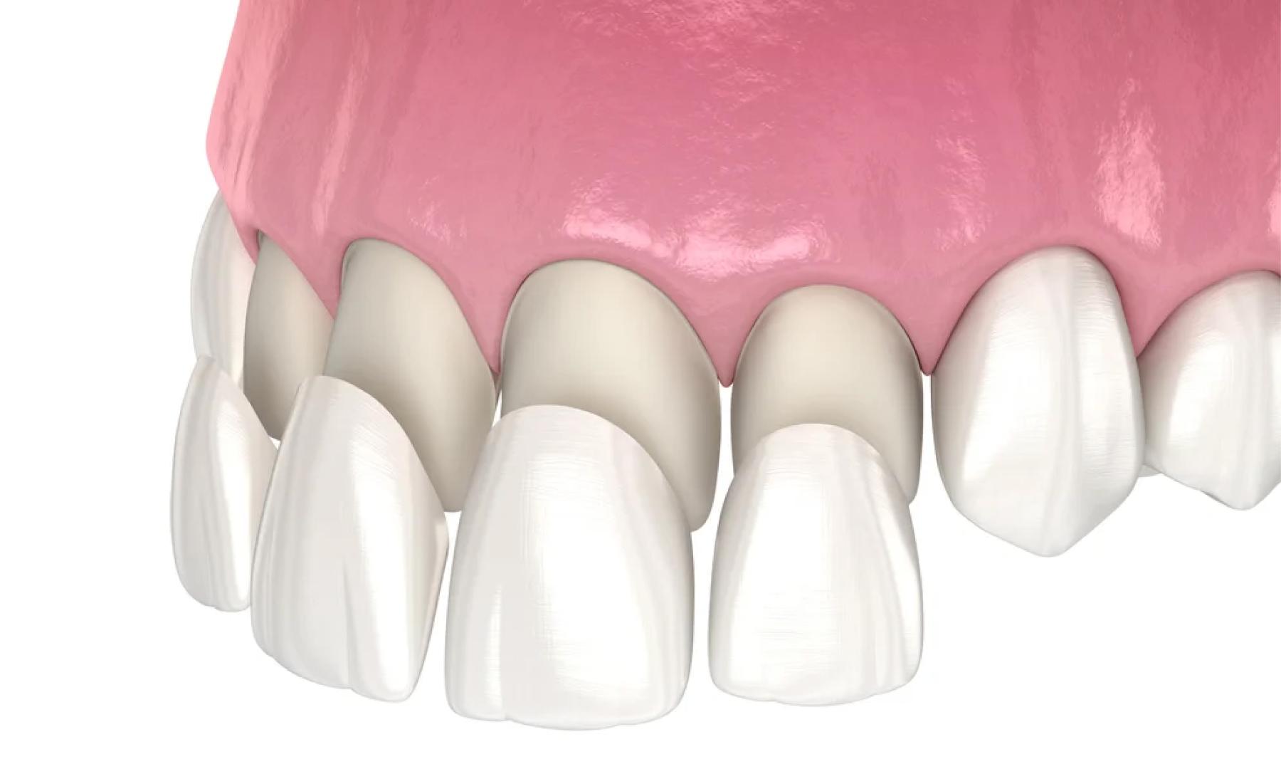  Porcelain veneers in Cancun Mexico as part of a smile makeover