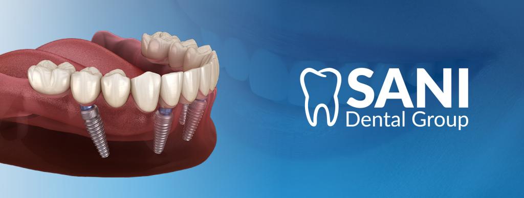 Dental Implants Cost in Mexico: What Patients Should Know in 2026