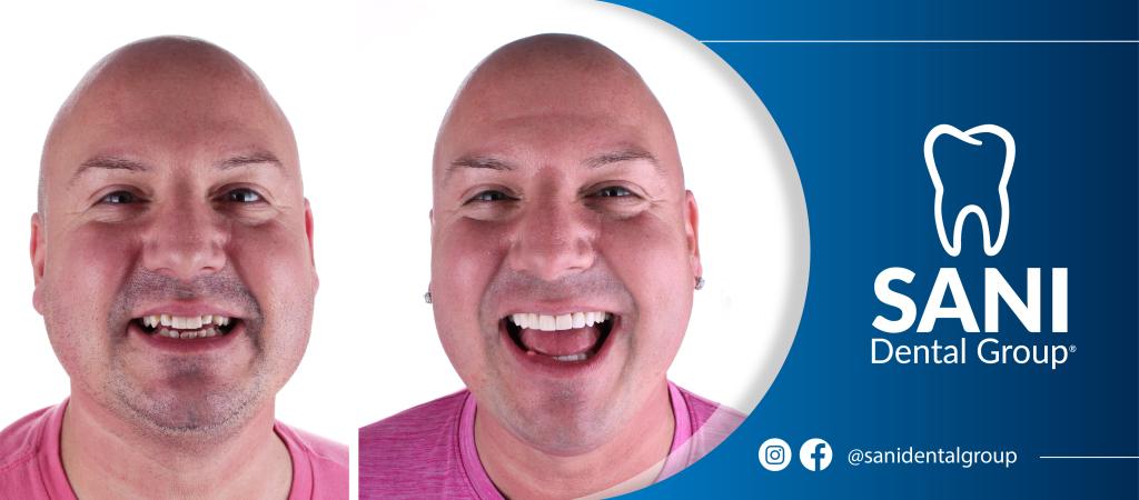 Veneers Cancun Mexico: Smile Makeovers With Advanced Cosmetic Dentistry