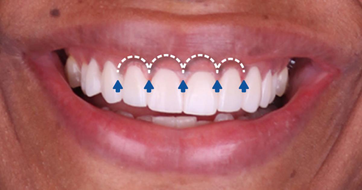 Crown Lengthening Procedure at Sani Dental Group