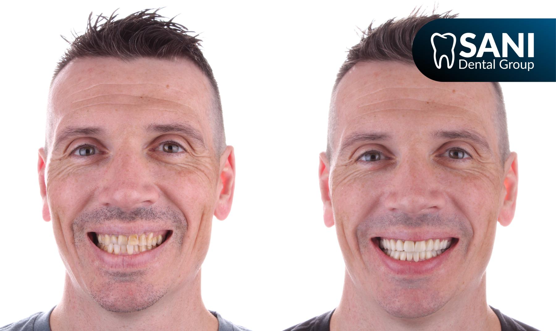 Smile makeover before and after of American patient in affordable dental clinic in Mexico