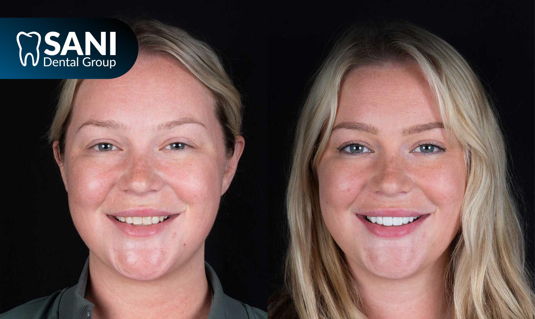 Sani-dental-group-affordable-veneers-in-cancun-mexico Before and after of american getting veneers done in Cancun Mexico