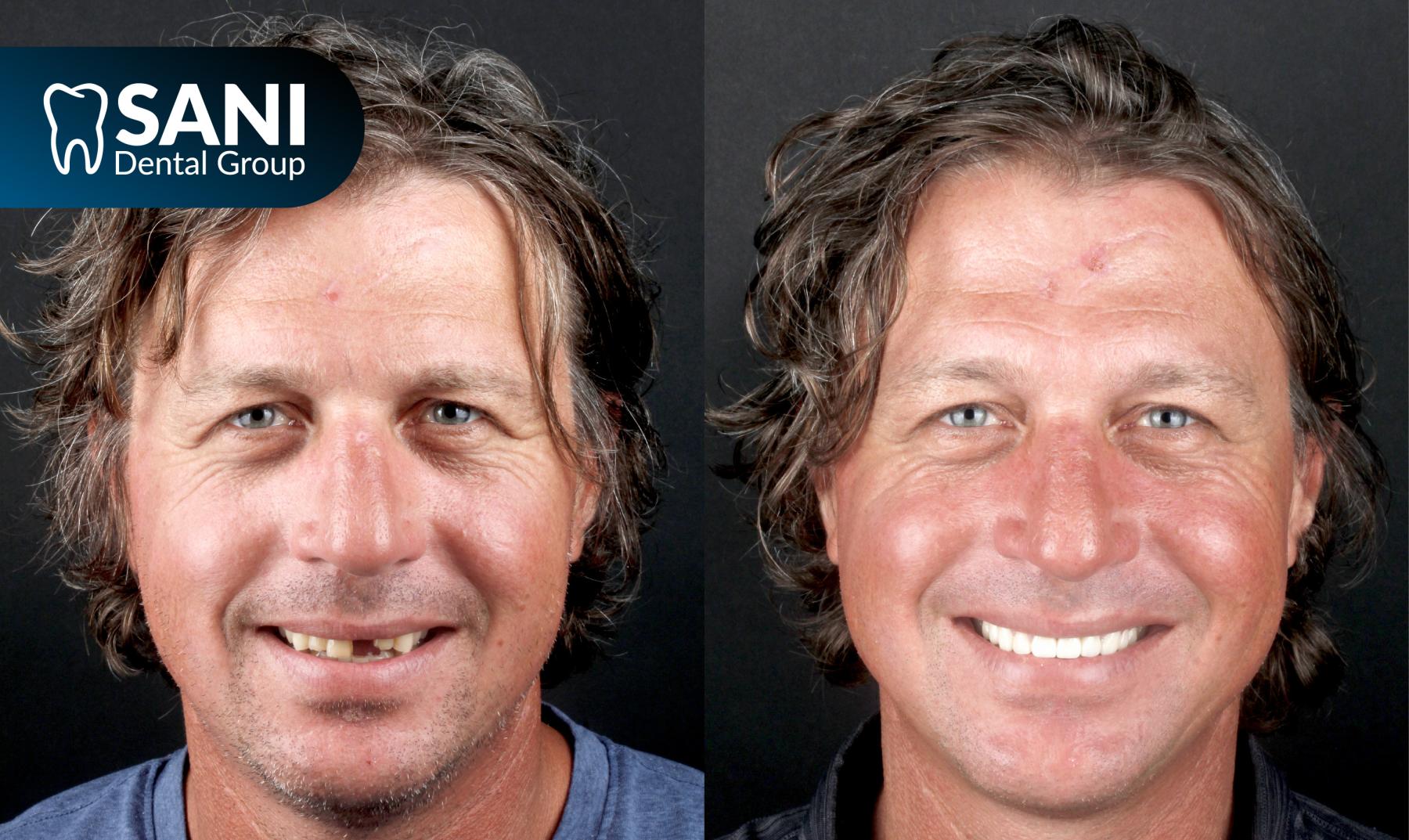 Before and after of Sani Dental Group patient getting affordable all on 4 dental implants in mexico