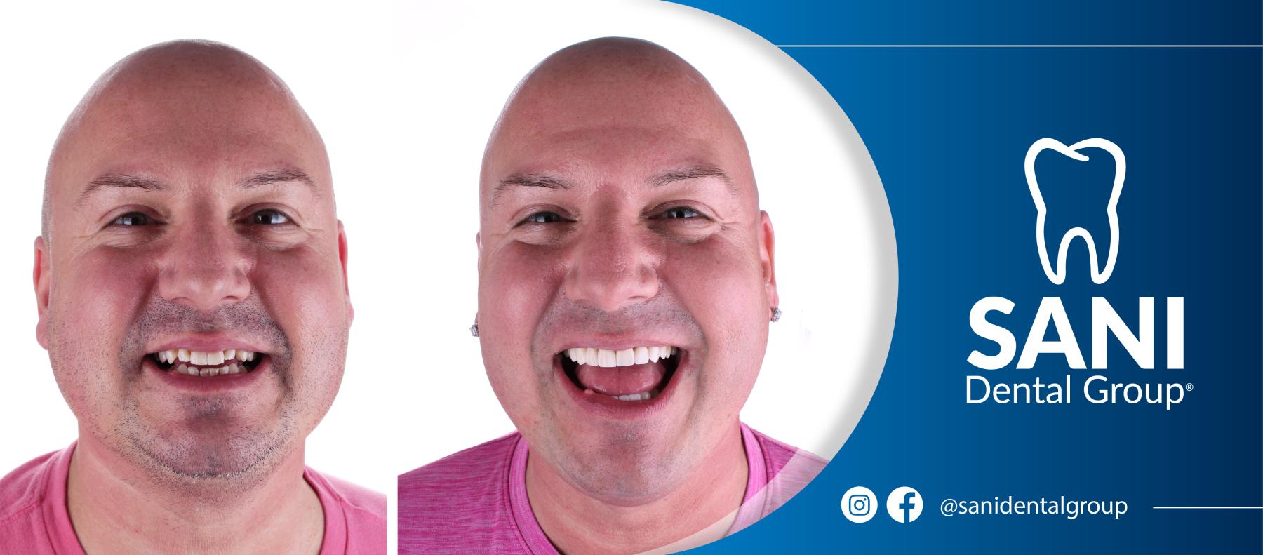 American patient getting affordable veneers in Mexico