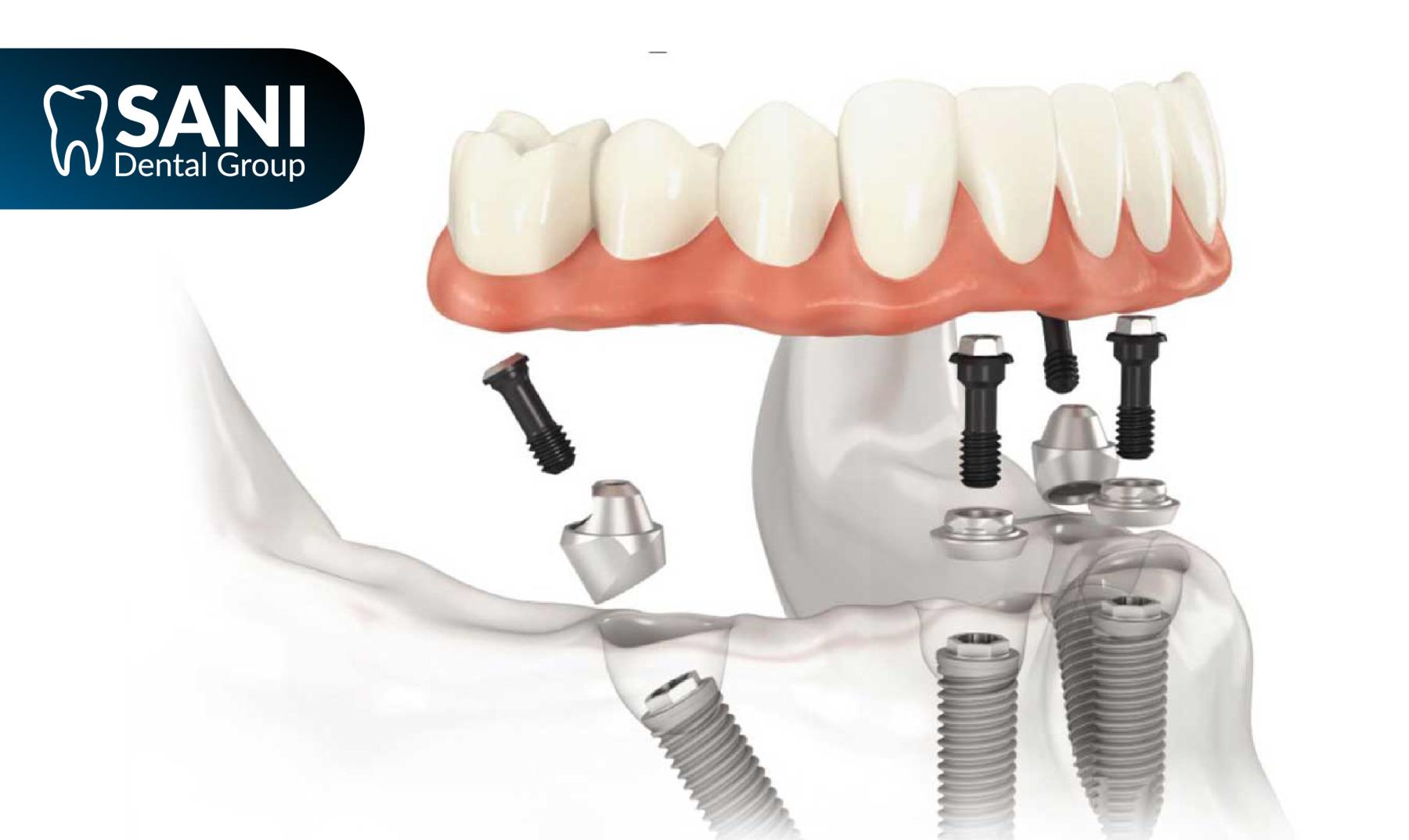 Sani-dental-group-how-do-all-on-4-work-top-clinic-cancun How All on 4 dental implants work for American patients in Cancun Mexico