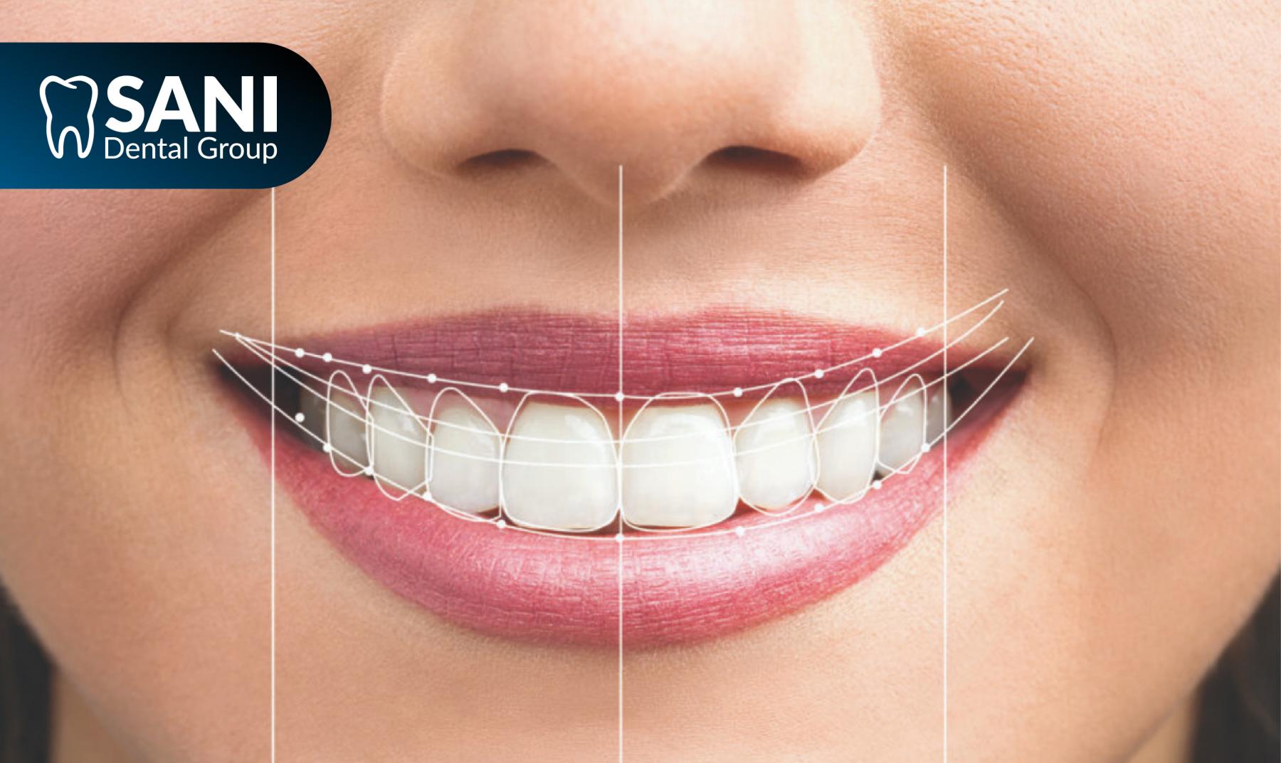Personalized veneers visualization at Sani Dental Group