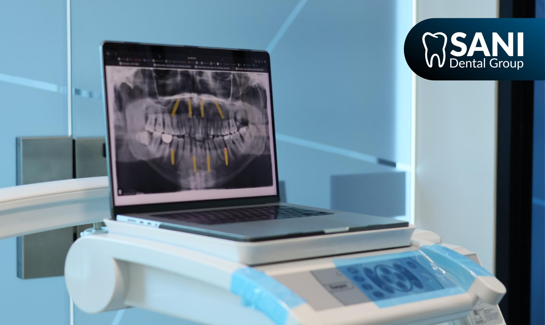 cancun-dental-implants