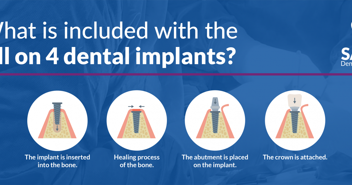 A Quick Guide on the All On 4 Dental Implants Procedure
