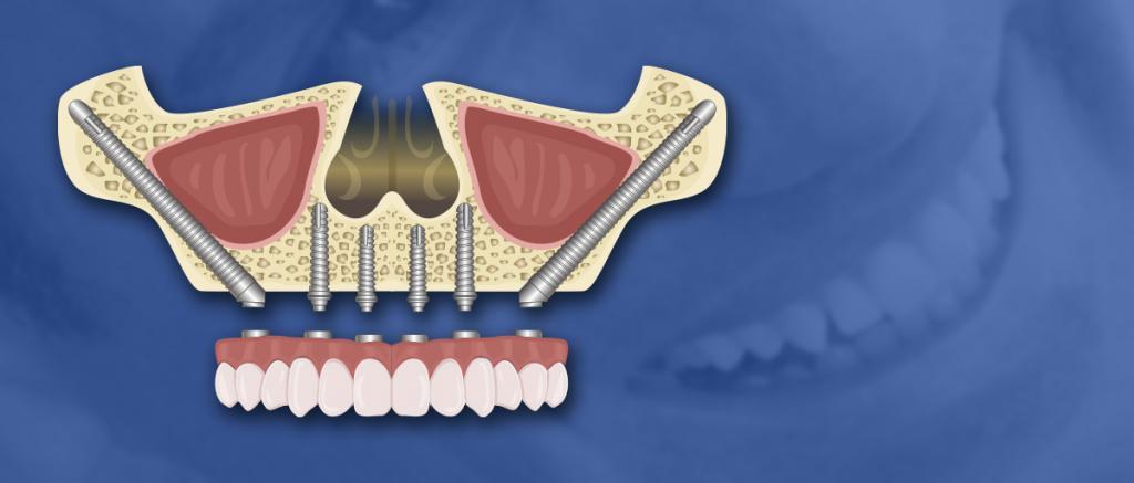 Zygomatic Implants Cost in Mexico