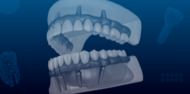 All-on-4 Dental Implants