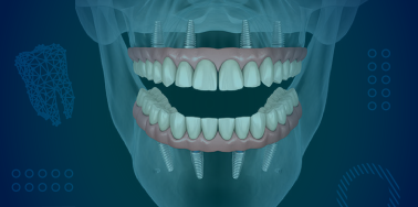 "All on Four" System with Acrylic Hybrid Fixed Denture (Upper or lower arch) **