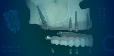 Pterygoid Implants
