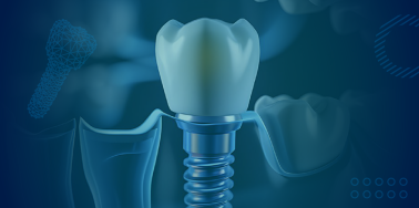 Single & Multiple Tooth Implants