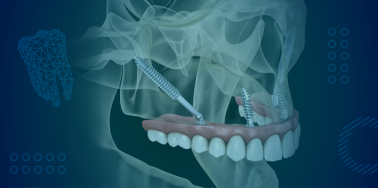 Zygomatic Dental Implants