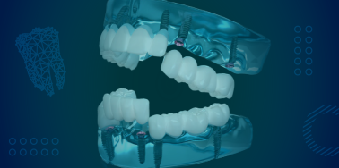 3 on 6 Dental Implants