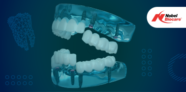 "All on Six" System with Nobel Biocare Implants **