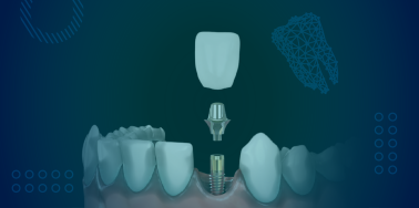 Standard Implant Crown (including abutment)