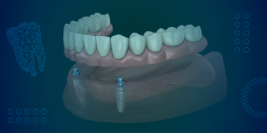 Implant Supported Overdenture, removable (with 2 implants) **