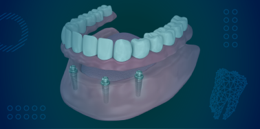 Implant Supported Overdenture, removable (with 3 implants) **