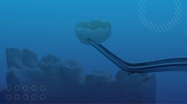 Dental Crowns