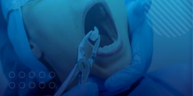 Dental Extractions