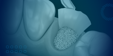 Bone Graft