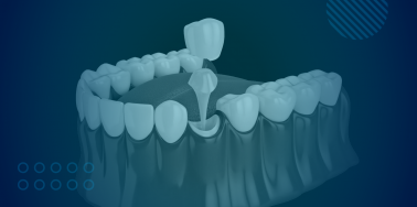 Post/Core Build-Up