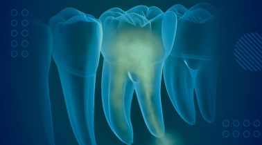 Root Canal