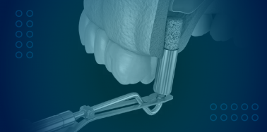 Sinus Lift