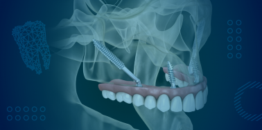 Zygomatic Dental Implants