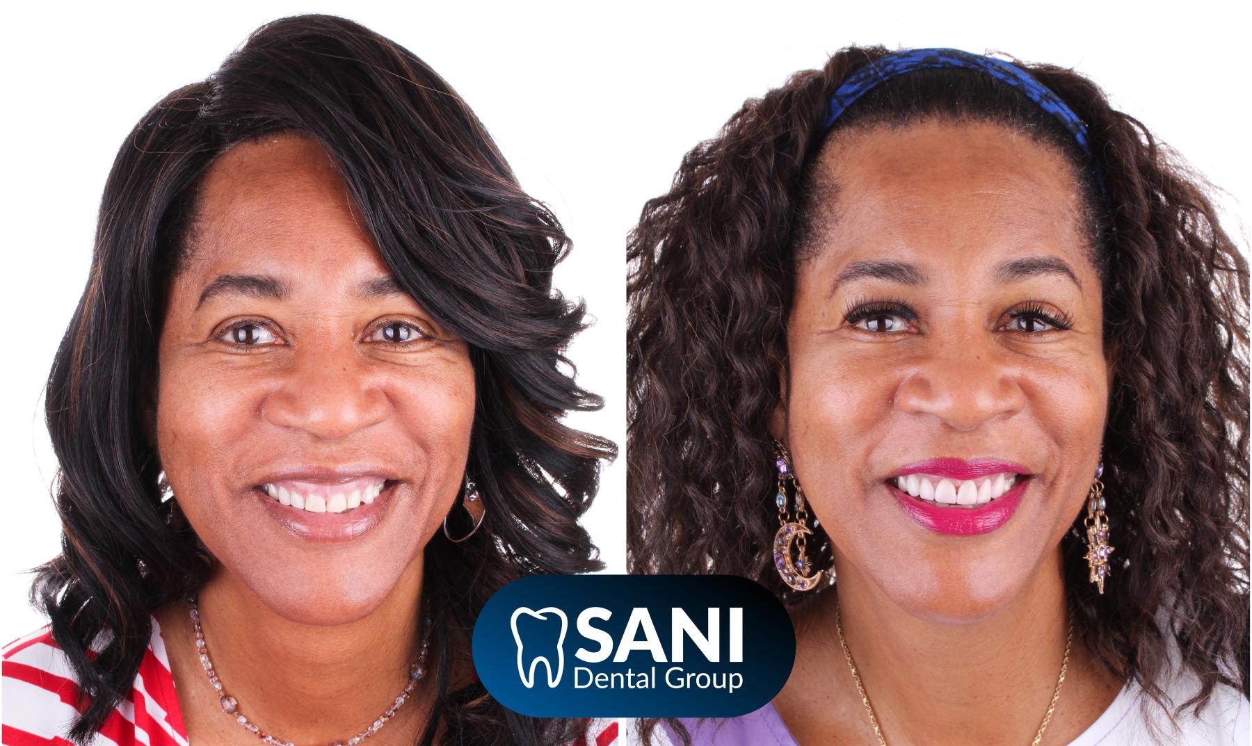before and after smile makeover results Mexico