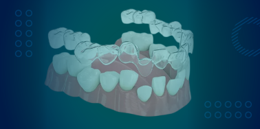 Clear Aligners
