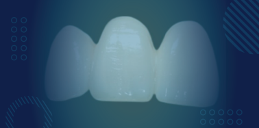 E-max (Full Porcelain/Ceramic) Crown